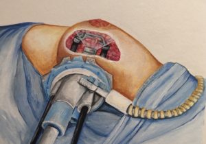 Robotic Approach for Nipple Sparing Mastectomy